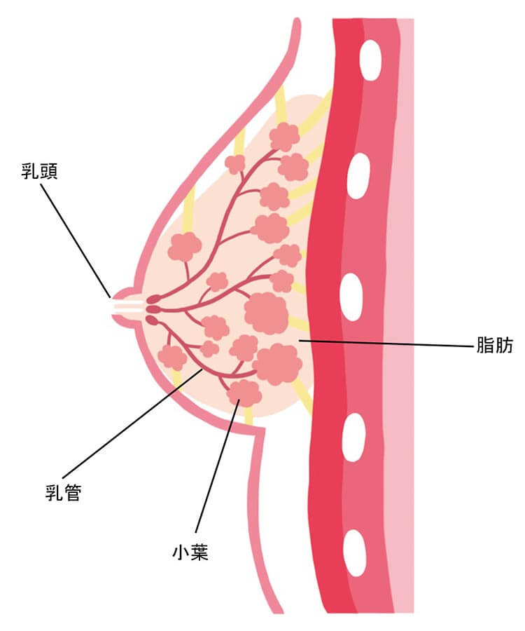 乳がんの種類の説明図