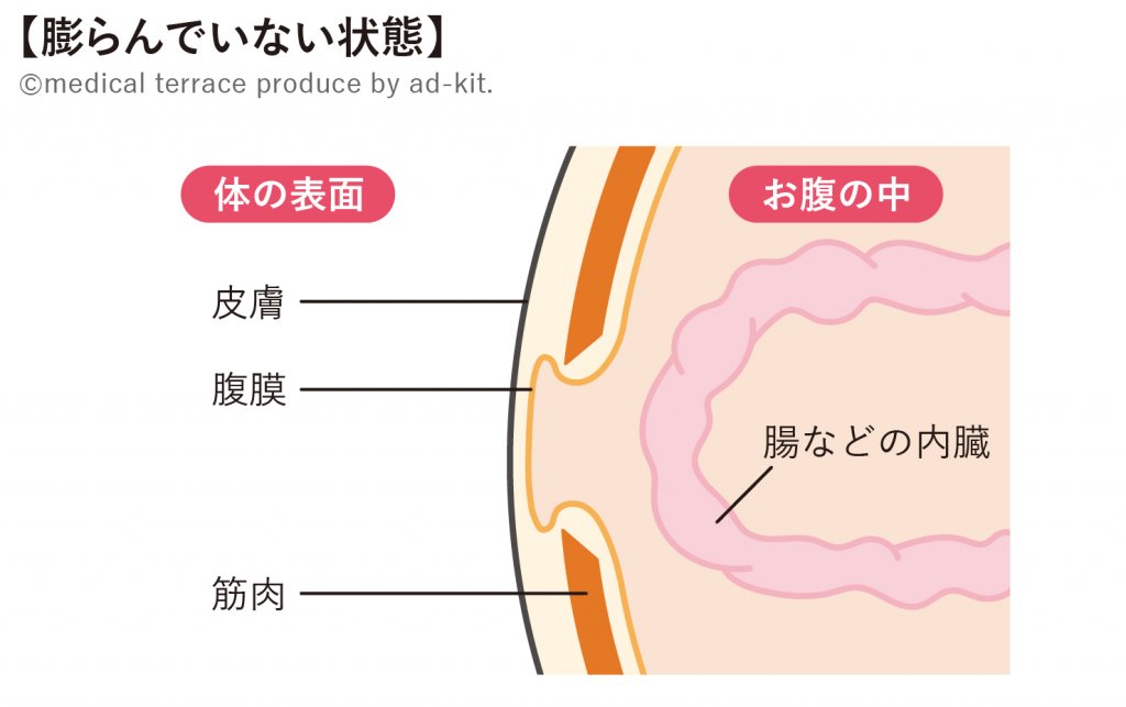 ヘルニア膨らんでいない状態