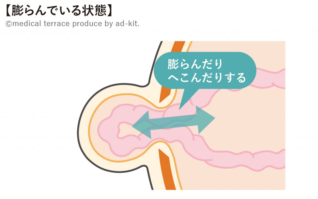 ヘルニア膨らんでいる状態