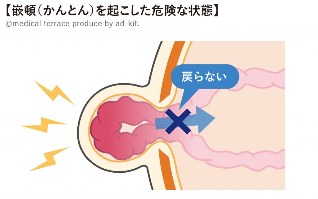 ヘルニア危険な状態